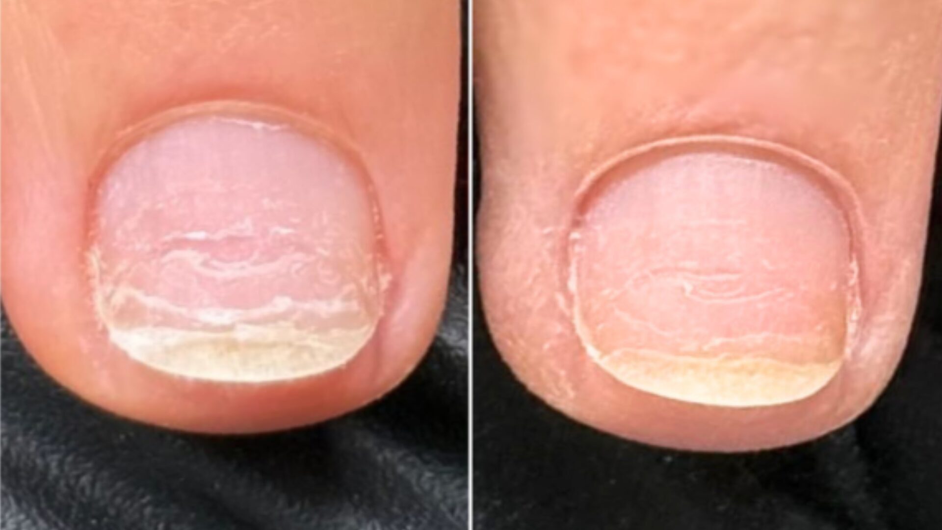 IBX Nail Strengthening Treatment Image 3